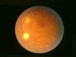 esclerosis-tuberosa-nervio-optico-hamartoma