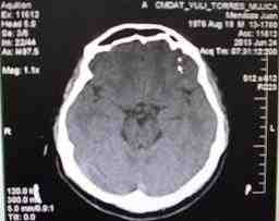 neurocisticercosis-TAC