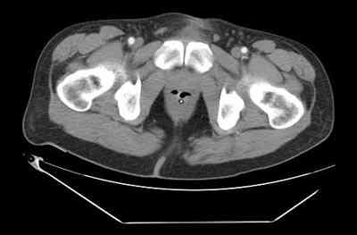 TAC-abdominal-adenocarcinoma-recto