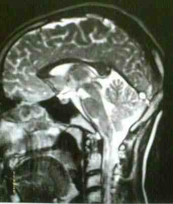 torcula-RMN-sagital