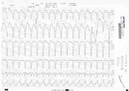 ECG 1_2