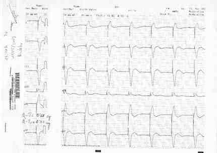 ECG-2_1