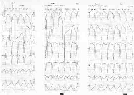 ECG-2_2