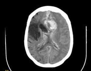 TAC-hemorragia-cerebral