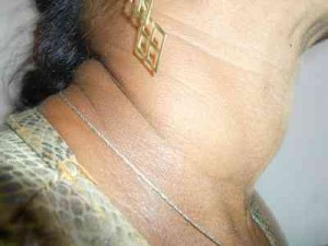 Tiroiditis-Hashimoto