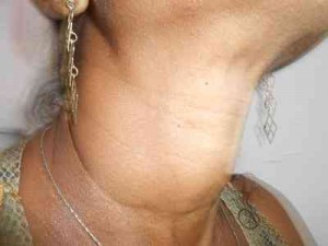 Tiroiditis-Hashimoto-caso-clinico