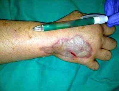 extravasacion-bicarbonato-edema