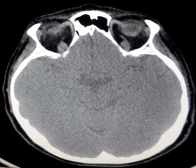 osteoma-craneal-tac