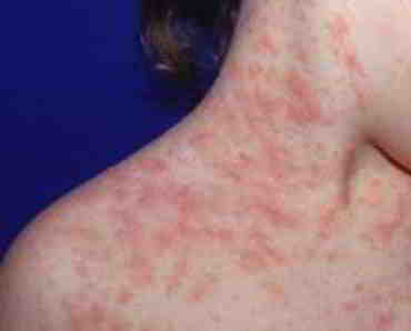 pitiriasis-rosada-Gilbert