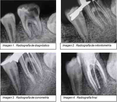 radix-entomolaris-caso-clinico