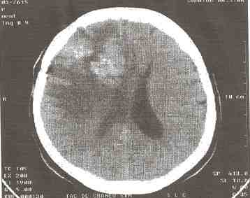 tumor-cerebral-TAC