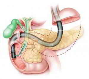 Colangiopancreatografia-Endoscopica-CPRE