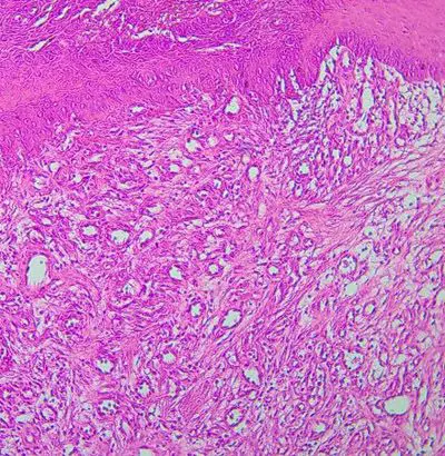 Figura 1. Tinción con Hematoxilina-eosina mostro incrementada cantidad de vasos sanguíneos con abundantes eritrocitos e infiltrado inflamatorio. 100X.