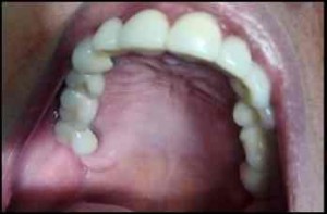 Lesion-exofitica-paladar