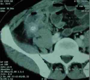 TAC-abdomen-coprolito