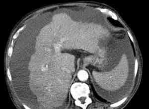 TAC-cirrosis-traumatismo-hepatico