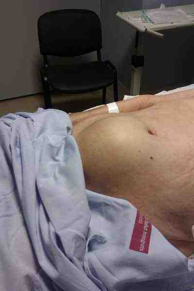 abdomen-globo-vesical