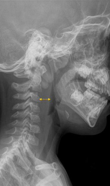Fig. 1 Radiografía cervical proyección lateral. Engrosamiento de los tejidos blandos retrofaríngeos-prevertebrales (signo indirecto).