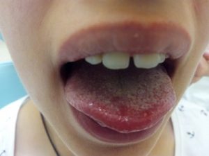 afta-menor-lengua