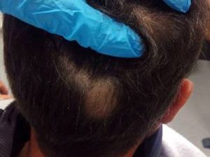 alopecia-areata