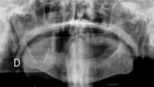 ameloblastoma-mandibular