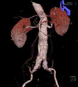 aneurisma-aorta-abdominal-yuxtarrenal