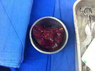 bazo-trauma-esplenico-esplenectomia