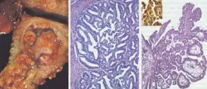 cancer-endometrio-morfologia