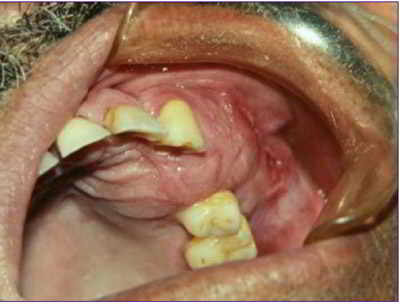 carcinoma-odontogenico-de-celulas-claras