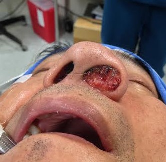 carcinoma-sebaceo-del-vestibulo-nasal