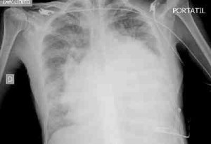 cardiomegalia-arbol-podado