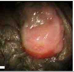colonoscopia-trombosis-hemorroidal