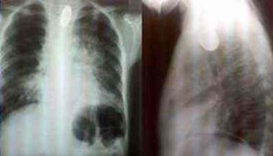 cuerpo-extraño-radioopaco-esofago