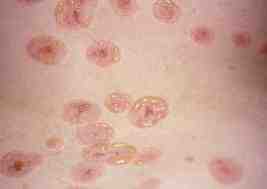 dermatosis-ampollosa