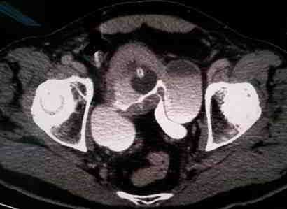 diverticulos-paraureterales-TAC