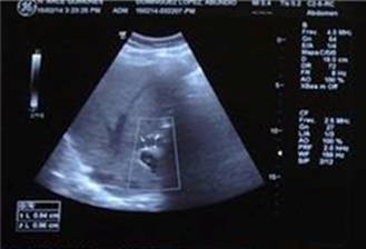 ecografia-abdominal-dilatacion-vias-biiares