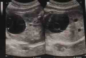 ecosonografia-fetal-31-semanas