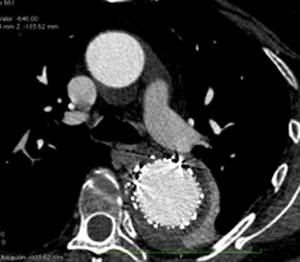 endoprotesis-aorta-toracica