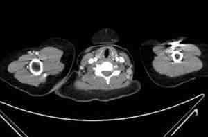 enfermedad-still-TAC-adenopatias