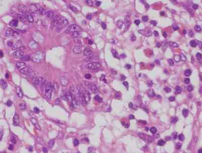 enteritis-eosinofilica