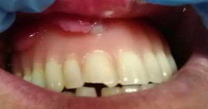 epulis-fisurado-con-la-protesis