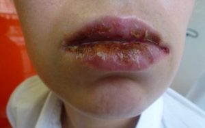 eritema-multiforme-persistente-mucosa-oral