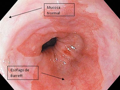 esófago-de-Barrett-EB-mucosa-columnar