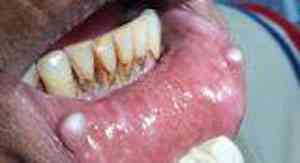 fibromas-traumaticos-succion-labial
