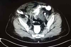 fistula-colovesical