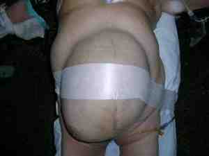 hematoma-gigante-abdominal