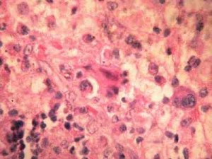 hemofagocitosis. Histiocitos-con-emperipolesis