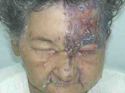herpes-oftalmico