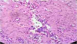 infiltracion-eosinofilos-enteritis