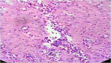 infiltracion-eosinofilos-enteritis